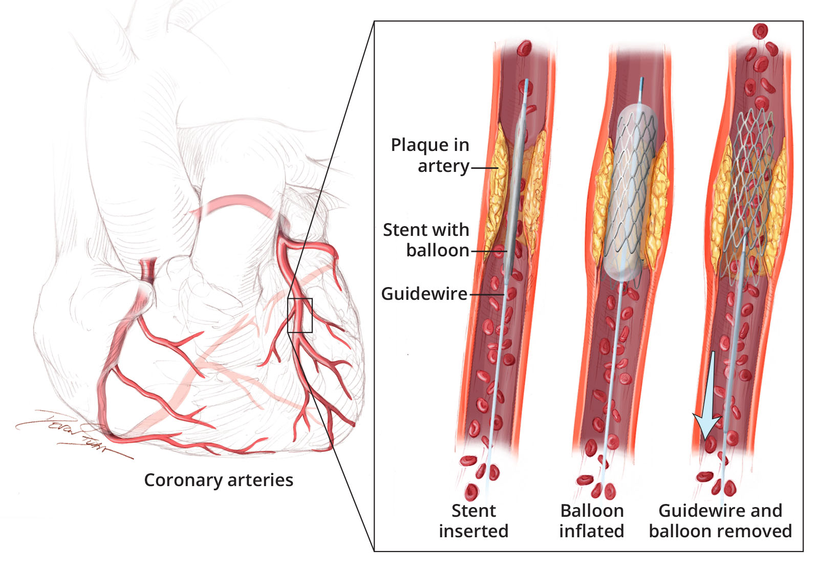 TRIPLE VESSEL DISEASE STENTING - Dr Kiran Lakkireddy Cardiologist Hyderabad