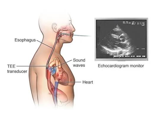 Transesophageal echocardiography TEE procedure in Hyderabad