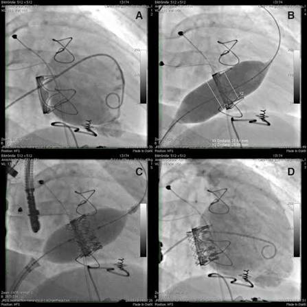 Tricuspid Valve Implantation