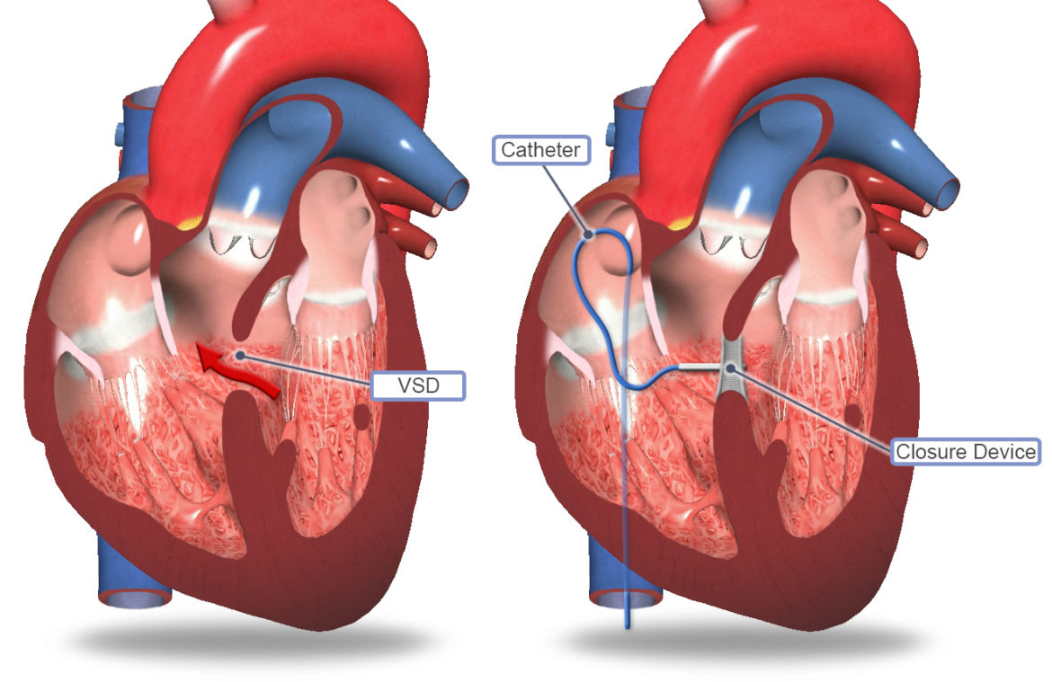 VSD DEVICE CLOSURE - Dr Kiran Lakkireddy Cardiologist Hyderabad
