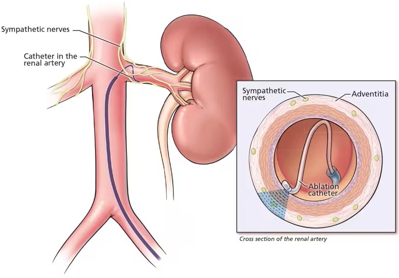 Renal Denervation Therapy