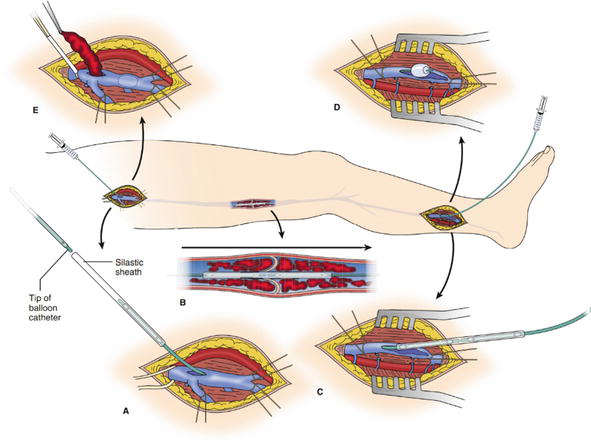 Proximal Iliofemoral DVT
