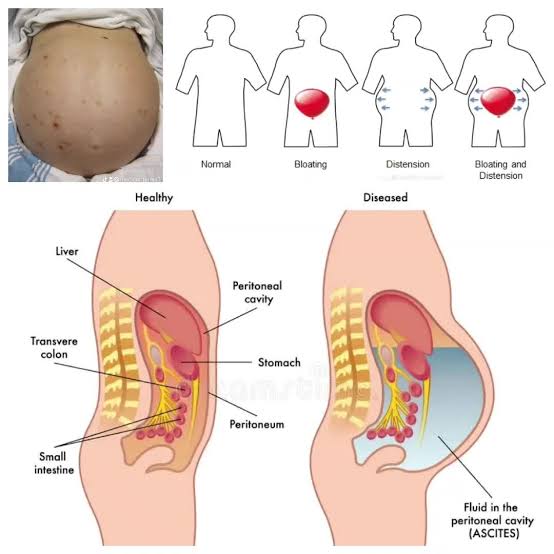 Abdominal Distension Evaluation in Hyderabad | Heart Care