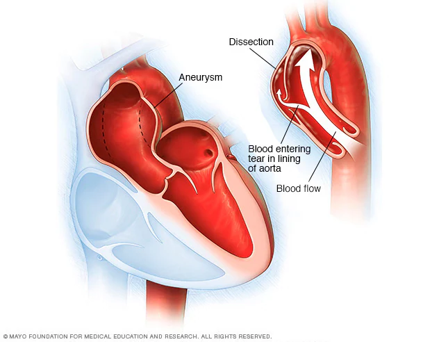 Aortic Disorders Treatment in Hyderabad | Aortic Care