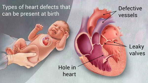 Congenital Heart Disease Treatment in Hyderabad