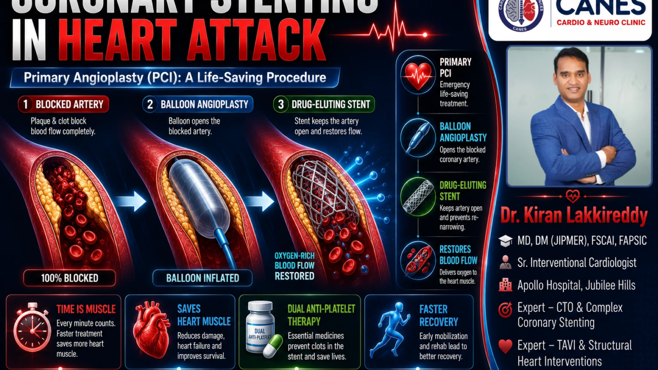 Crucial Guide: Coronary Stenting in Heart Attack & Recovery