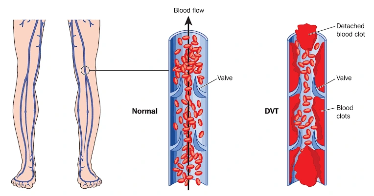 Deep Vein Thrombosis Treatment in Hyderabad | DVT Care