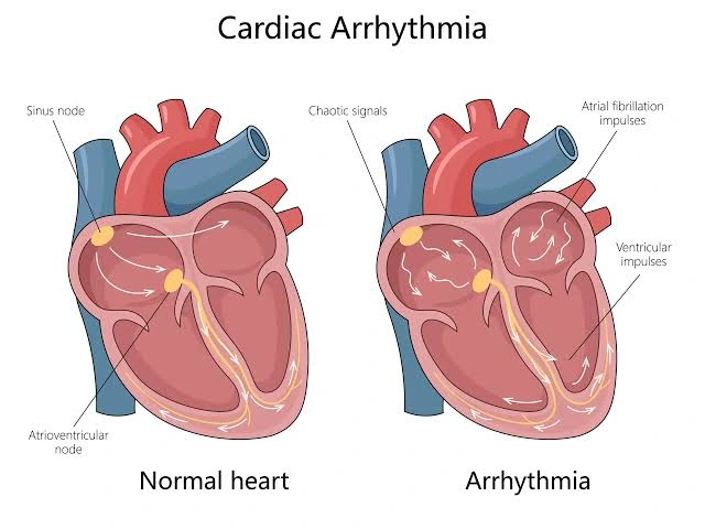Heart Arrhythmia Treatment in Hyderabad | Rhythm Care