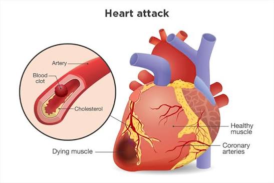 Heart Attack Treatment in Hyderabad