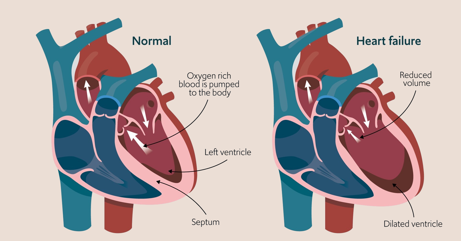 Heart Failure Treatment in Hyderabad | Heart Specialist