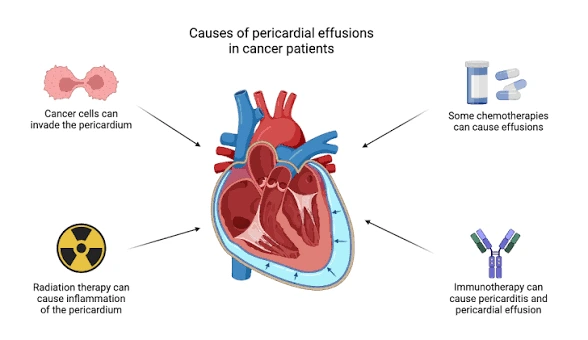 Pericardial Disorders Treatment in Hyderabad