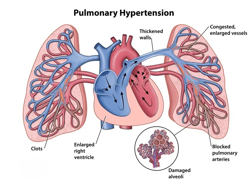 Pulmonary Hypertension and Pulmonary Thromboembolism in Hyderabad