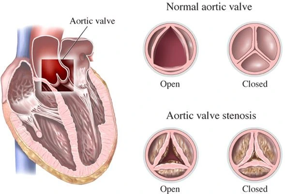 Valvular Heart Disease Treatment in Hyderabad | Valve Care