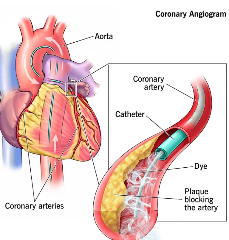 Coronary Angiogram | Hyderabad | Dr. Kiran Lakkireddy