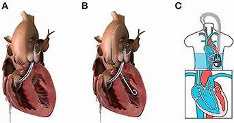 Mechanical Circulatory Support