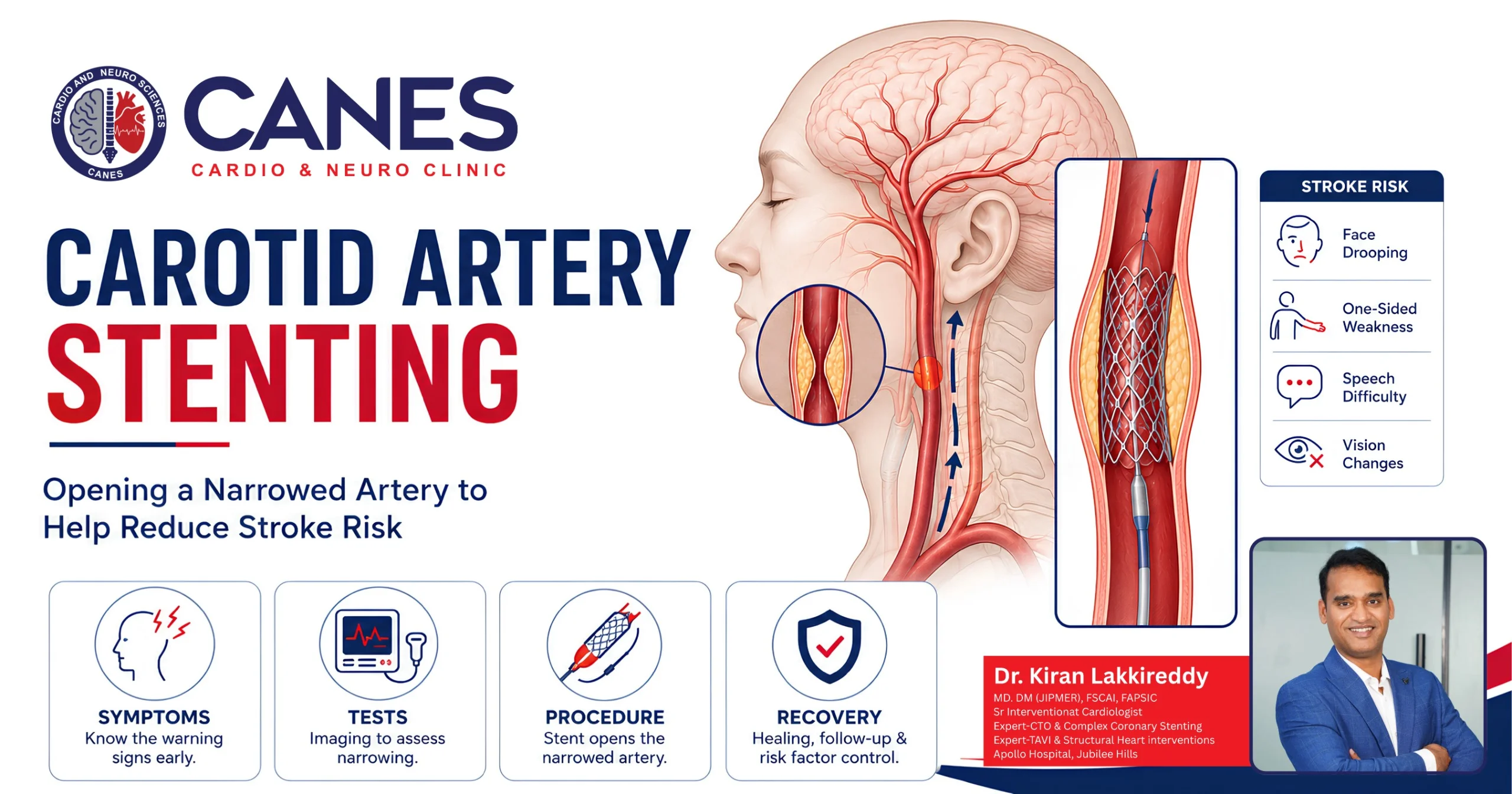 Carotid Artery Stenting: Your Complete Stroke Prevention Guide